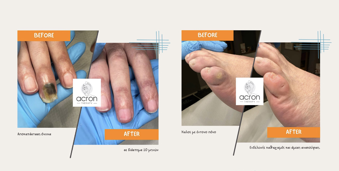 ACRON Therapy