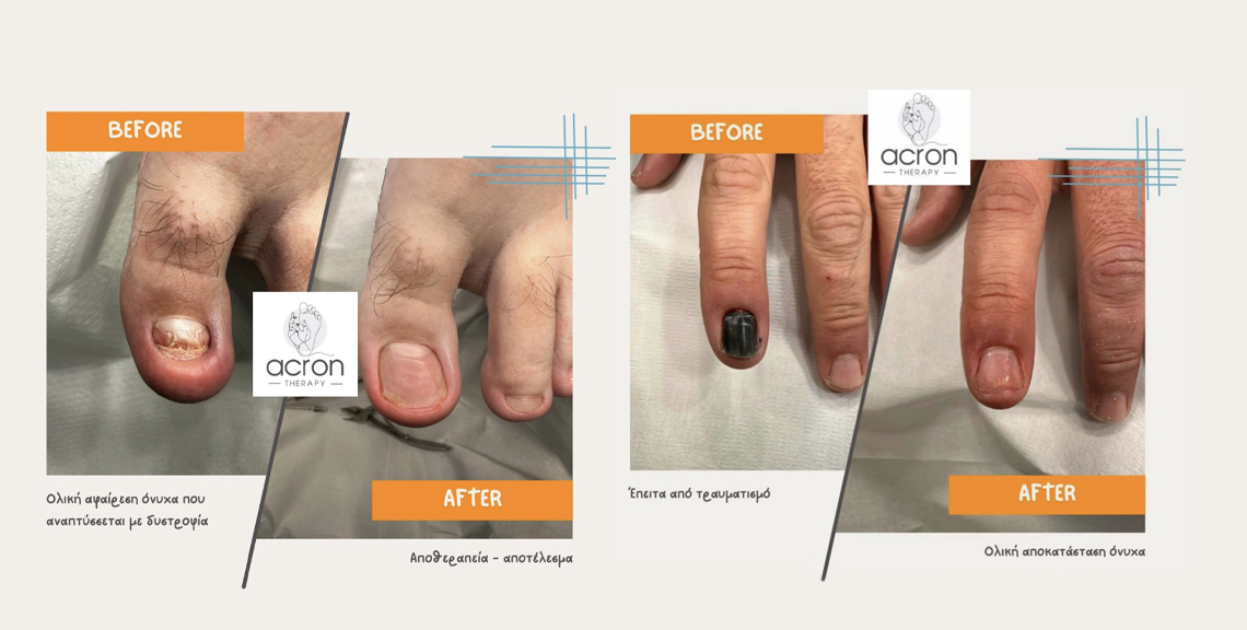 ACRON Therapy
